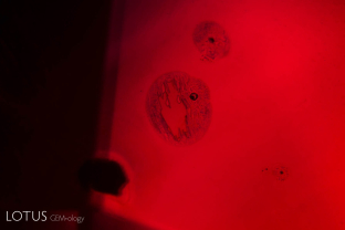 Some inclusions in Mozambique rubies are thermally sensitive. Here we find small crystals that have melted. The melted crystal (glass) occupies less volume than the original crystal, resulting in a frozen contraction bubble. A small fingerprint surrounds each melted crystal.