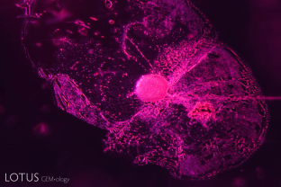 A  melted crystal with a frosted surface surrounded by a fingerprint with melted channels. Often known as a "saturn inclusions,” these melted crystals are common in heated Thai ruby.
