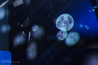 Melted crystals with circular heat-induced “bubbly” fingerprints and partially dissolved silk in a heated sapphire from Sri Lanka; FOV 2 mm